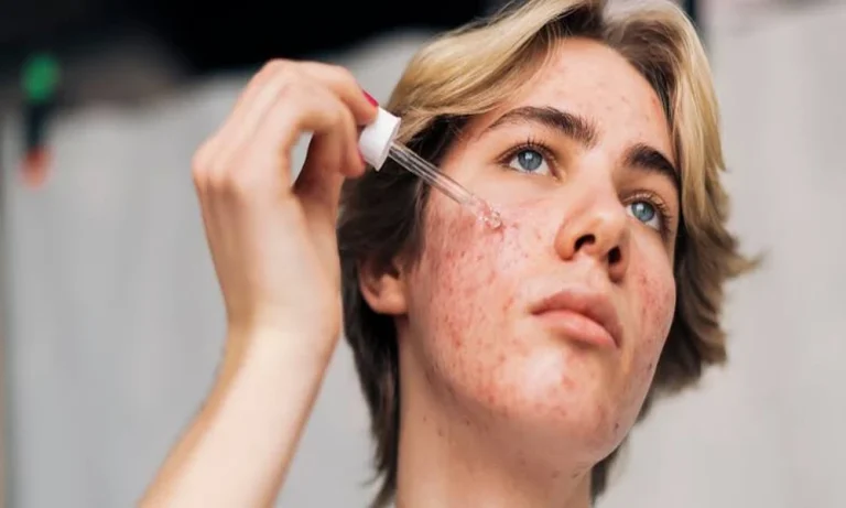 Acne beyond the Pimple: The Skin Changes beneath the Surface